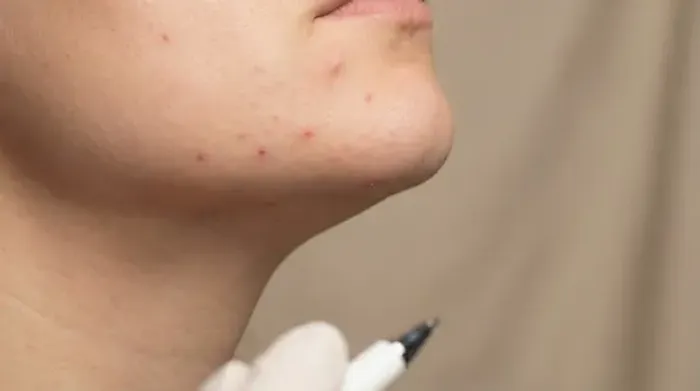 Understanding and Managing Jawline Acne
